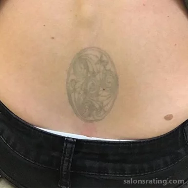 Removery Tattoo Removal & Fading, Austin - Photo 3