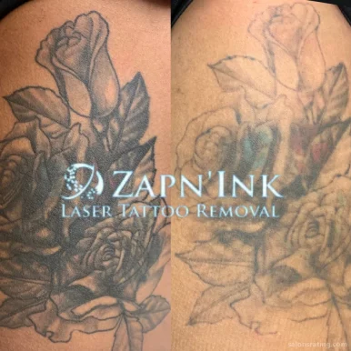 Zapn'Ink Laser Tattoo Removal, Beaumont - Photo 1