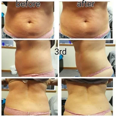 Dream Bodies non surgical liposuction and facelifts, Boise - Photo 8