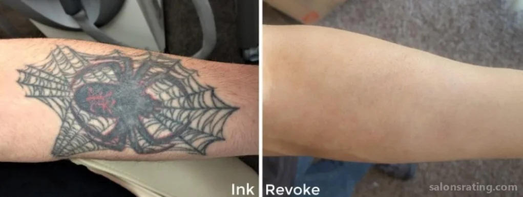 Ink Revoke Tattoo Removal, Boulder - Photo 2