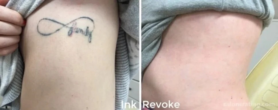 Ink Revoke Tattoo Removal, Boulder - Photo 1