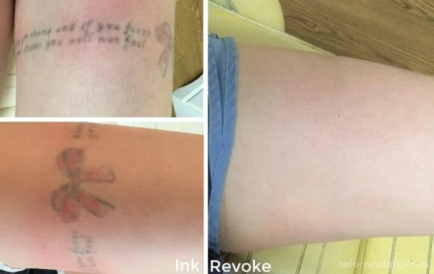 Ink Revoke Tattoo Removal, Boulder - Photo 5