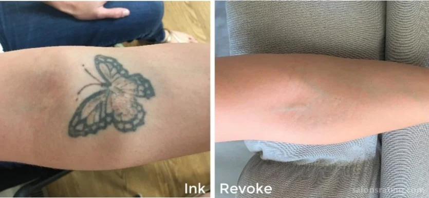 Ink Revoke Tattoo Removal, Boulder - Photo 7