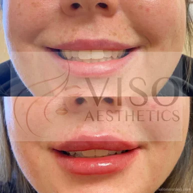 Botox and Lip Fillers by Viso Aesthetics, Chandler - Photo 4