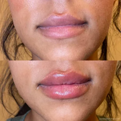 Botox and Lip Fillers by Viso Aesthetics, Chandler - Photo 1