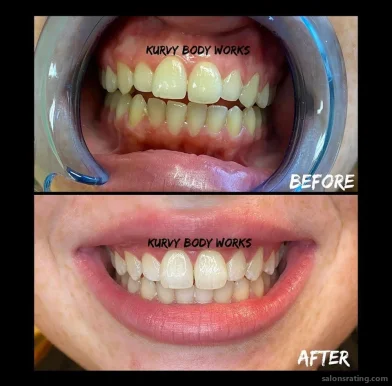 Kurvy Body Works: Body Contouring & Cosmetic Teeth Whitening, Charlotte - Photo 4