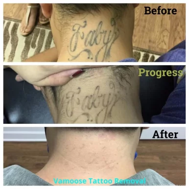 Removery Tattoo Removal & Fading, Chicago - Photo 3
