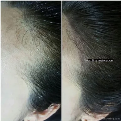 OM SCALP Micropigmentation and Hairline Tattoo Clinic, Chicago - Photo 3