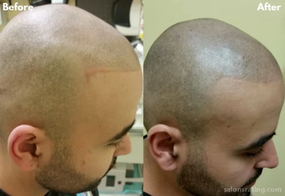 OM SCALP Micropigmentation and Hairline Tattoo Clinic, Chicago - Photo 4