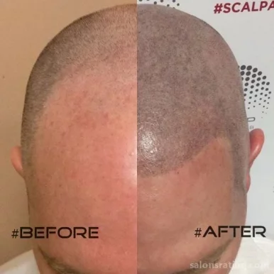 OM SCALP Micropigmentation and Hairline Tattoo Clinic, Chicago - Photo 6