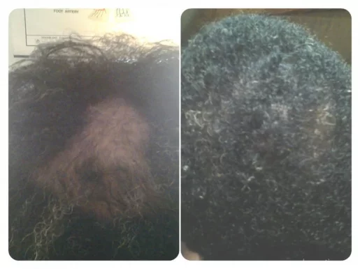 Hair Loss Control Clinic Dallas, Dallas - Photo 5