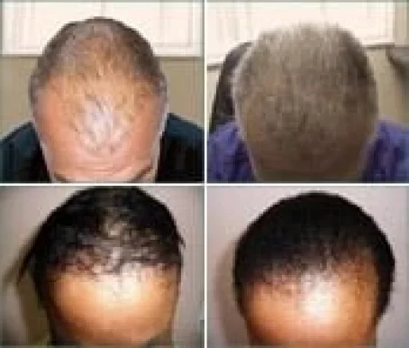 Hair Loss Control Clinic Dallas, Dallas - Photo 6