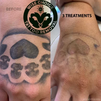 Wise Choice Tattoo Removal, Denver - Photo 5