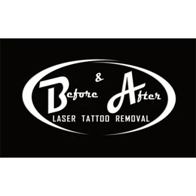 Before & After Laser Tattoo Removal, El Paso - Photo 4