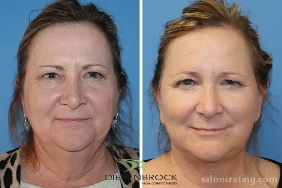 Diepenbrock Facial Cosmetic Surgery, Fort Wayne - Photo 3
