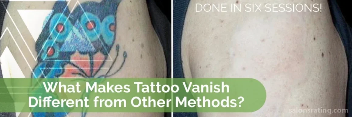 Tattoo Vanish, Hialeah - Photo 3