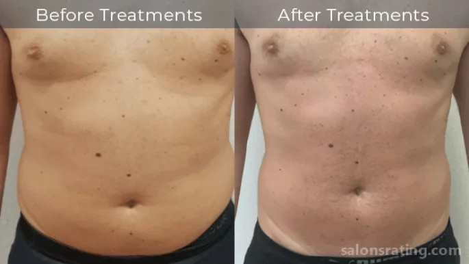 TRACE | Body Rejuvenation - Sports Recovery, Pain Relief, and Aesthetics, Houston - Photo 3