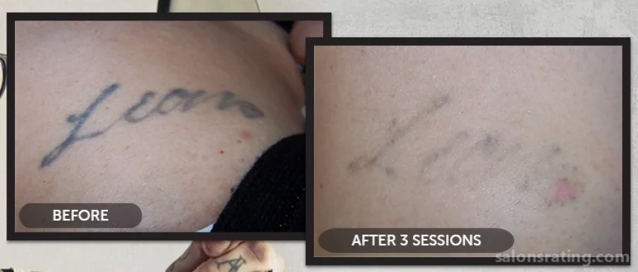 Indy Laser Tattoo Removal, Indianapolis - Photo 3