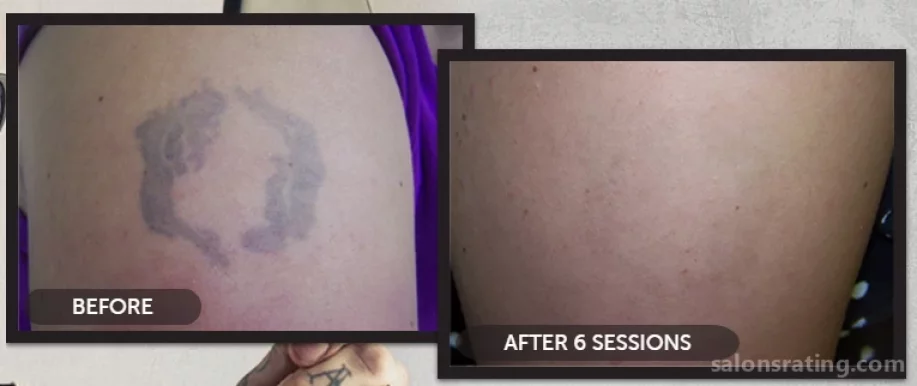 Indy Laser Tattoo Removal, Indianapolis - Photo 2