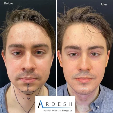 Farhad Ardeshirpour, MD - Ardesh Facial Plastic Surgery, Irvine - Photo 4