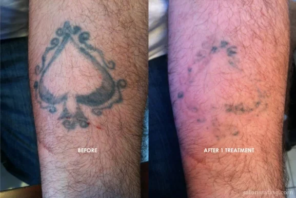 Tattoo Removers.ink, Los Angeles - Photo 1