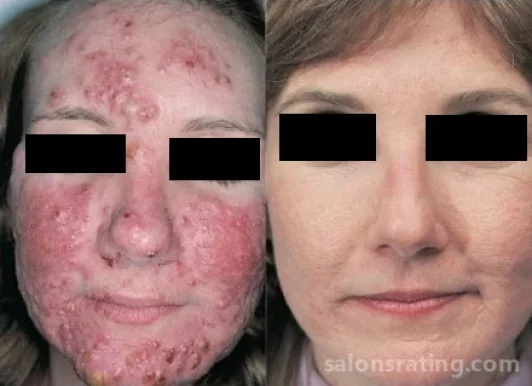 Permanent Makeup, Acne And Skin Care By Shoshana, Los Angeles - Photo 6