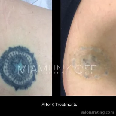 Miami Ink Off Tattoo Removal Clinic, Miami - Photo 5