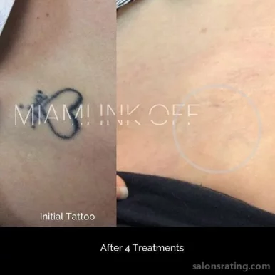 Miami Ink Off Tattoo Removal Clinic, Miami - Photo 2