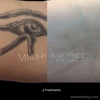 Miami Ink Off Tattoo Removal Clinic, Miami - Photo 6