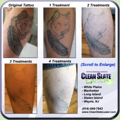 Clean Slate Laser Tattoo Removal, New York City - Photo 1