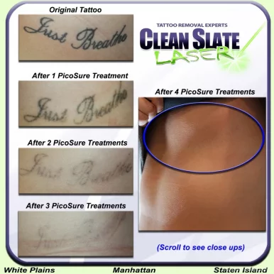 Clean Slate Laser Tattoo Removal, New York City - Photo 5
