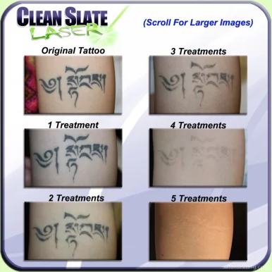 Clean Slate Laser Tattoo Removal, New York City - Photo 4