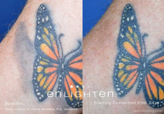 Laser Tattoo Removal NYC, New York City - Photo 4
