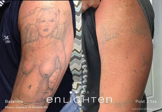 Laser Tattoo Removal NYC, New York City - Photo 7