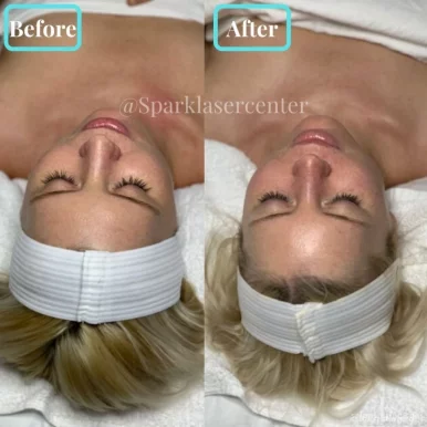 Spark Laser Center - Best Laser Hair Removal, Midtown Medical Spa, Microneedling, Hydrafacial NYC, New York City - Photo 2