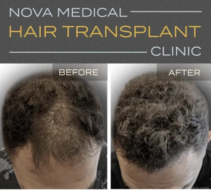 Hair Transplant NYC | Nova Medical Hair Transplant NYC, New York City - Photo 3