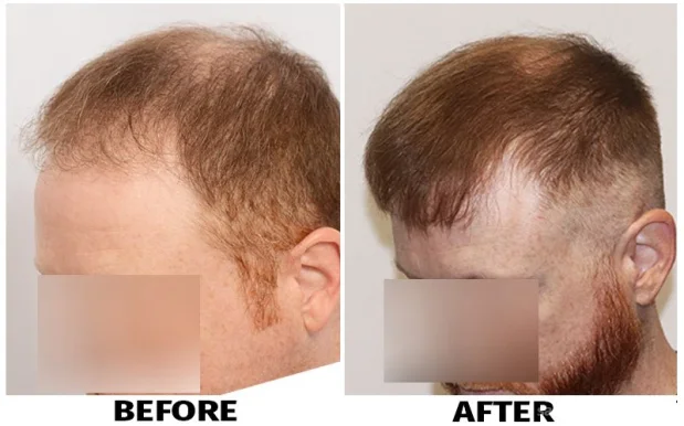 ForHair NYC Restoration Clinic - Dr. John Cole, New York City - Photo 2