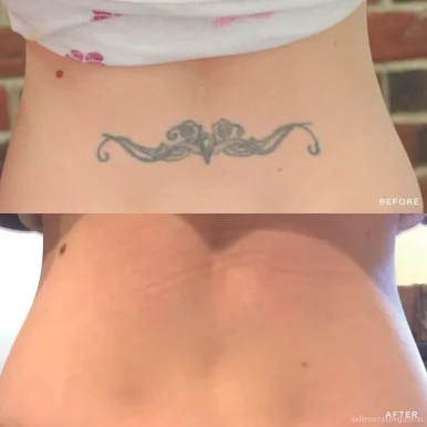 Removery Tattoo Removal & Fading, Oceanside - Photo 2