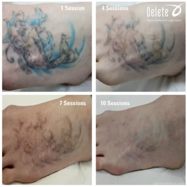 Removery Tattoo Removal & Fading, Phoenix - Photo 4