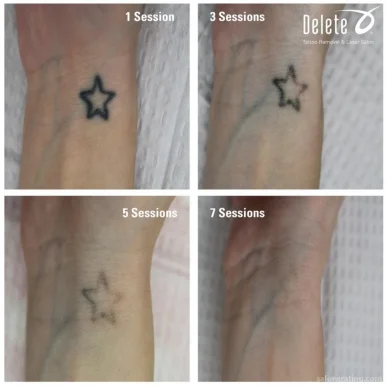 Removery Tattoo Removal & Fading, Phoenix - Photo 3