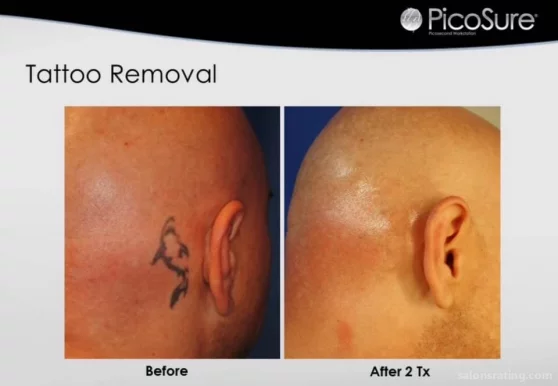 Phoenix Tattoo Removal and Skin Revitalization, Phoenix - Photo 3