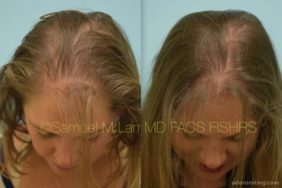 Samuel M. Lam, MD, FACS - Lam Institute for Hair Restoration, Plano - Photo 4