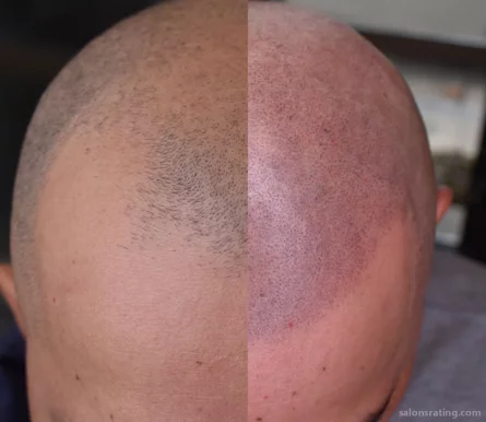 The Scalp Barber Scalp Micropigmentation Hair Loss Solution By Allure, Sacramento - Photo 1
