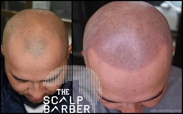 The Scalp Barber Scalp Micropigmentation Hair Loss Solution By Allure, Sacramento - Photo 8