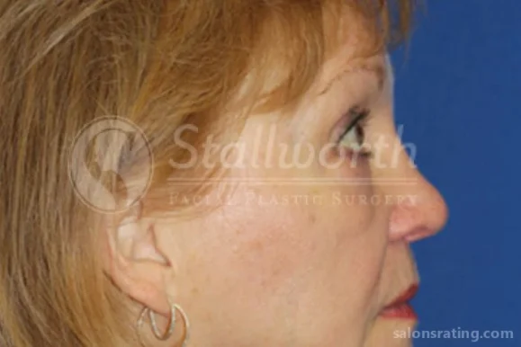 Stallworth Facial Plastic Surgery, San Antonio - Photo 4