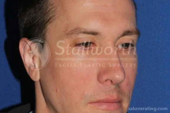 Stallworth Facial Plastic Surgery, San Antonio - Photo 6