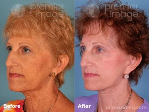 Premier Image Cosmetic & Laser Surgery, Sandy Springs - Photo 5