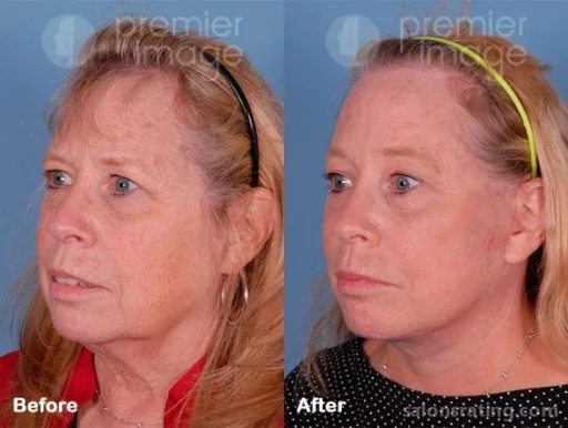 Premier Image Cosmetic & Laser Surgery, Sandy Springs - Photo 6