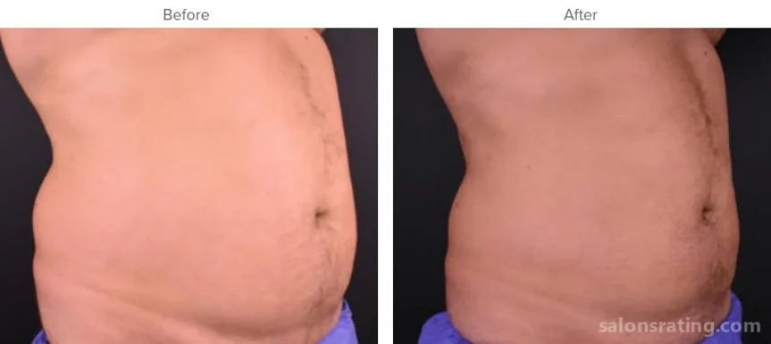 Keller Aesthetic Specialists CoolSculpting & SculpSure, Sandy Springs - Photo 4