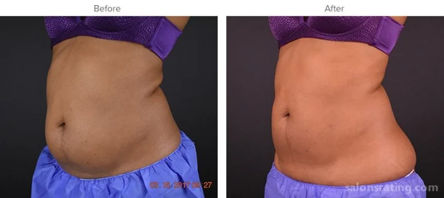 Keller Aesthetic Specialists CoolSculpting & SculpSure, Sandy Springs - Photo 6